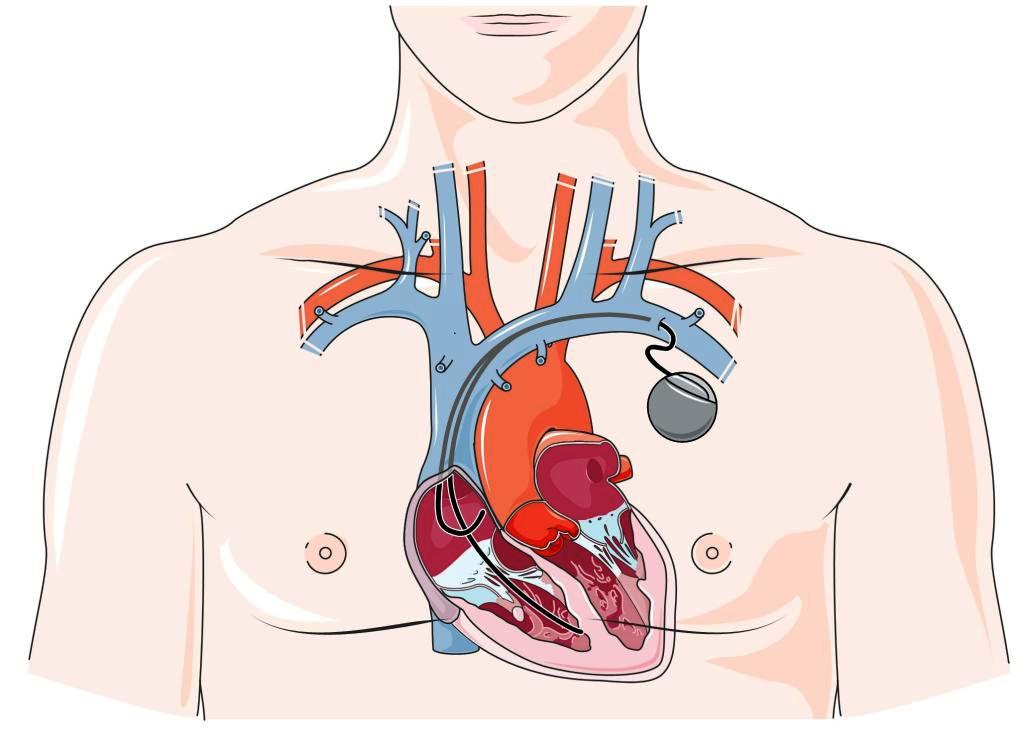 Сколько живут с кардиостимулятором. Сердечный кардиостимулятор. Имплантируемый кардиостимулятор. Операция кардиостимулятор сердца. Имплантируемые кардиовертеры-дефибрилляторы.