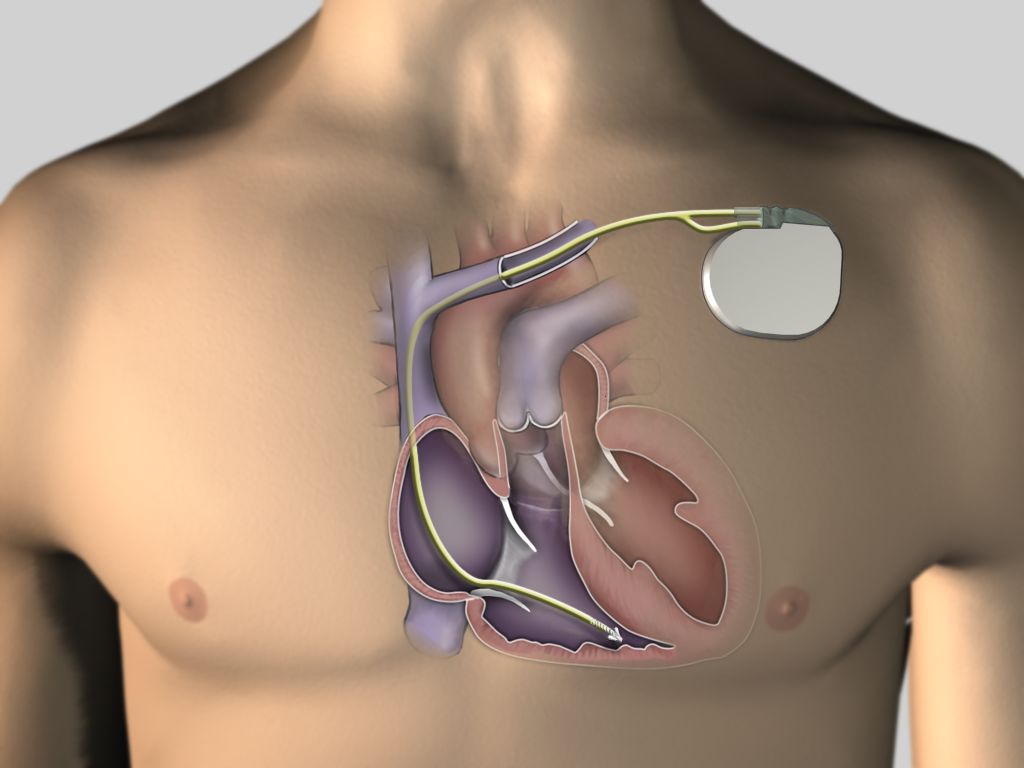 Implantierbarer Defibrillator Icd Hgz Gottingen
